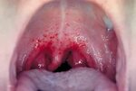 Strep Throat - Causes, Signs, Symptoms, Diagnosis, Antibiotic Treatment